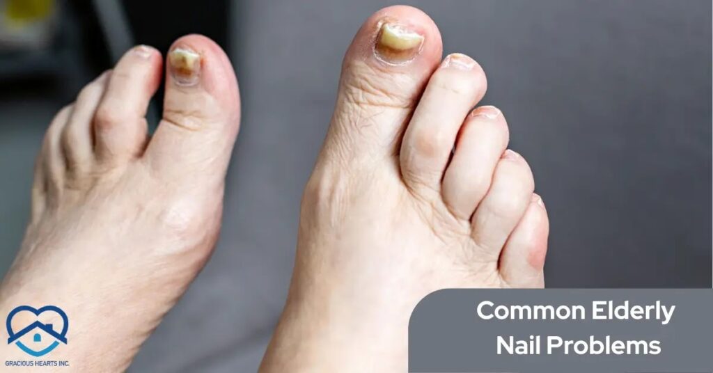 Common Nail Problems in the Elderly